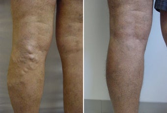 Varicose vein endovenous laser treatment