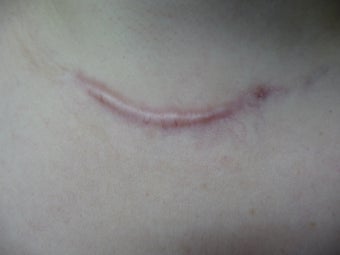Scar Revision Procedure for Thyroid Keloid Scar on the Neck and Chest