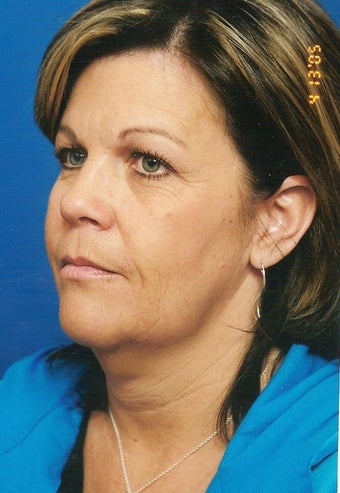 Neck Lift