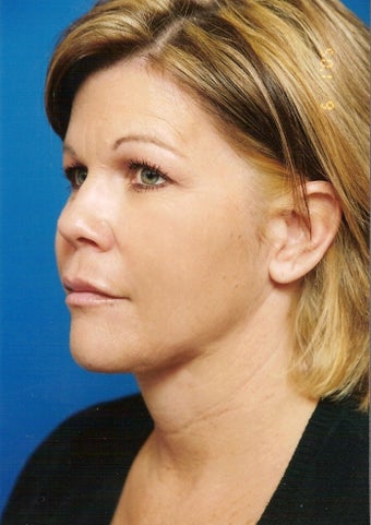 Neck Lift