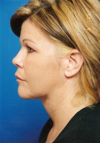 Neck Lift