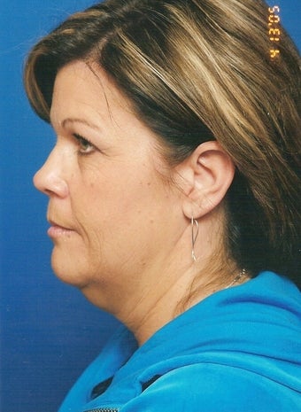 Neck Lift