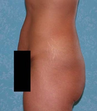 Circumferential Body Lift with Buttock Augmentation