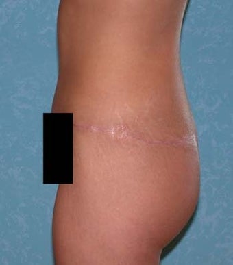 Circumferential Body Lift with Buttock Augmentation