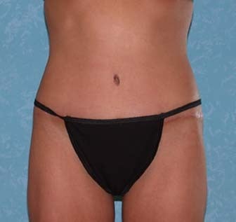 Circumferential Body Lift with Buttock Augmentation