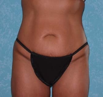 Circumferential Body Lift with Buttock Augmentation