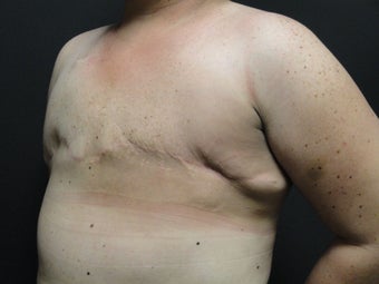 Flap-based breast reconstruction - DIEP