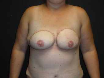 Flap-based breast reconstruction - DIEP