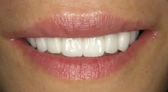 Smile Design