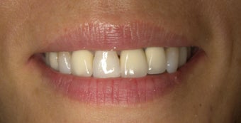 Smile Design