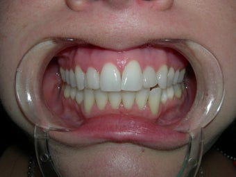 Dental veneer to correct small misaligned front teeth
