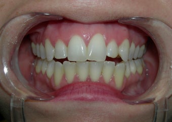Dental veneer to correct small misaligned front teeth
