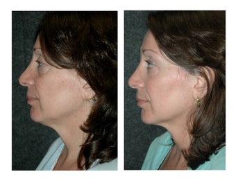 Lower Eyelid Lift (Extended) with Fat Transposition for Eye Bags