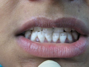 Laser Speed Tooth Whitening