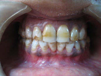 Laser Speed Tooth Whitening