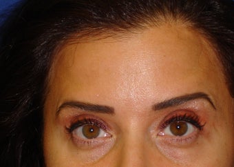 Forehead Lines