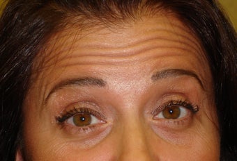 Forehead Lines