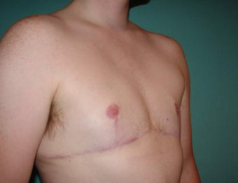 FTM chest masculinization in Chicagoland