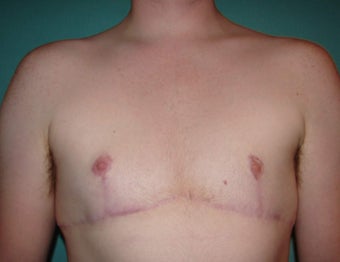 FTM chest masculinization in Chicagoland