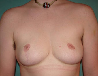 FTM chest masculinization in Chicagoland