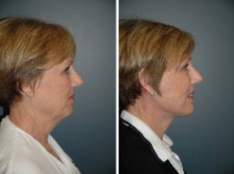 Face Lift