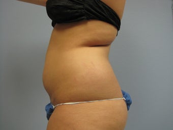 Liposuction of Abdomen and Waist