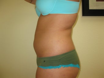 Liposuction of Abdomen and Waist