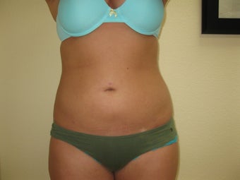 Liposuction of Abdomen and Waist