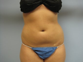 Liposuction of Abdomen and Waist