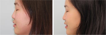 Double eyelid incisional surgery - before & 2 months post op