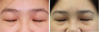 Double eyelid incisional surgery - before & 2 months post op