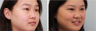 Double eyelid incisional surgery - before & 2 months post op