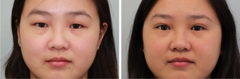 Double eyelid incisional surgery - before & 2 months post op