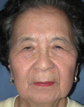 Lateral Browlift & Upper Lid Blepharoplasty