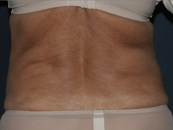 Liposculpture
