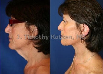 Neck liposuction only