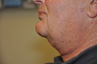 Necklift