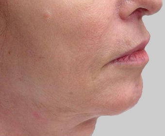 Exilis