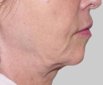 Exilis