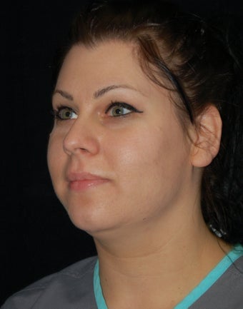Cheek Fat Pad Removal