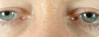 Eyelid Surgery