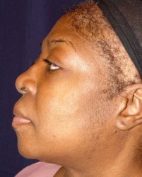 Rhinoplasty Side View