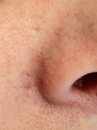 Laser Vein Removal
