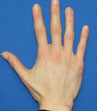 Hand Rejuvenation with Filler