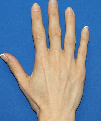 Hand Rejuvenation with Filler