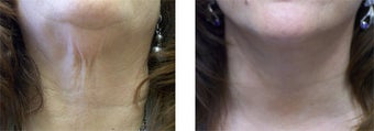 Face and Neck Lift