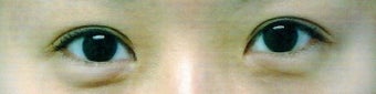 Bilateral Asian Eyelid Surgery w/ Medial Epicanthoplasty