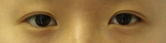 Bilateral Asian Eyelid Surgery w/ Medial Epicanthoplasty
