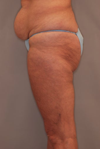 Thigh Lift