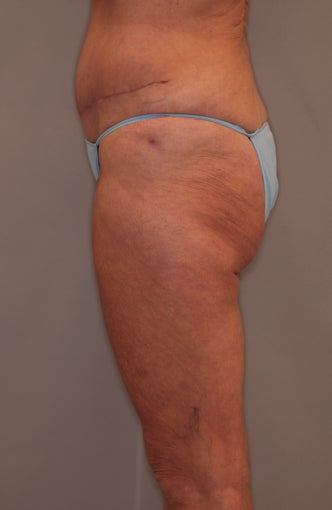 Thigh Lift
